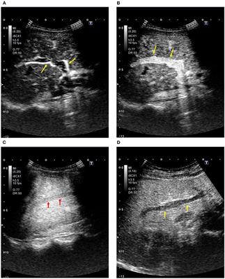 Contrast-enhanced ultrasonography for the management of portal hypertension in cirrhosis